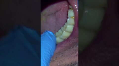 Dental Bridge (Replace Missing Teeth)