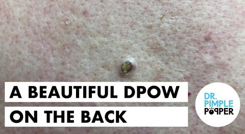 An Easy Peasy Dilated Pore of Winer