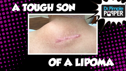 Push it out, Pull it out, Get. It. OUT! Lipoma