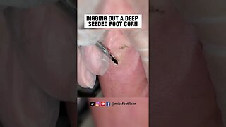 DIGGING OUT A DEEP SEEDED FOOT CORN 2023 | CORN TREATMENT BY FAMOUS PODIATRIST MISS FOOT FIXER