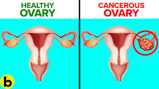 4 Ovarian Cancer Symptoms That Every Woman Needs To Know