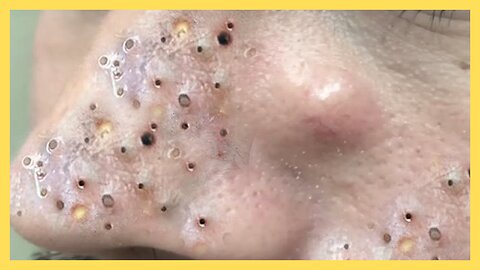 Giant Blackhead Extraction - How to Remove Blackheads satisfaction - blackhead removal