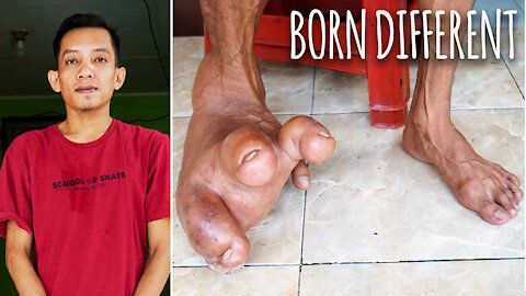 The Man With The Giant Foot | BORN DIFFERENT