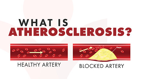 What is Atherosclerosis?
