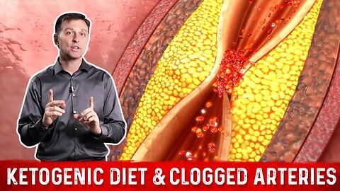 Is Keto Dangerous? High Fat Ketogenic Diet & Clogged Arteries – Dr. Berg