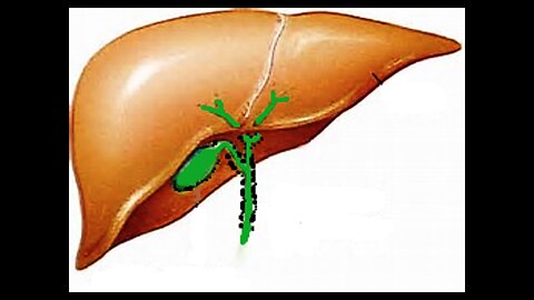 35. Gall Bladder, Gall stones