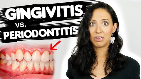 Do You Have Gingivitis or Periodontitis? | Different Stages Of Gum Disease