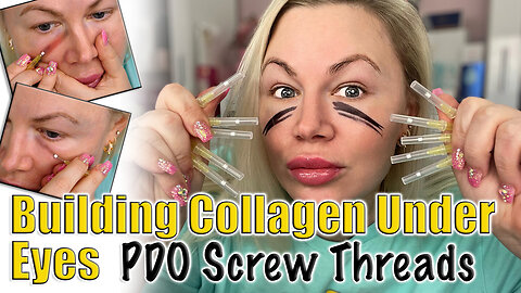 Building Collagen in my Under eyes with PDO Screw Threads! AceCosm | Code Jessica10 Saves you Money