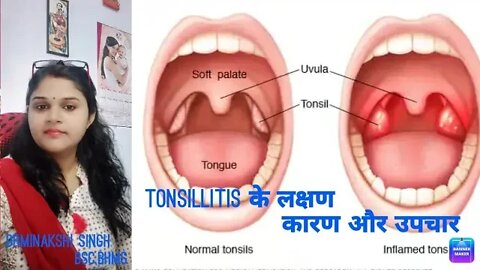 #Tonsillitis: Symptoms, Causes, Treatments, and Remedies #homeopathic #drminakshisingh #treatment