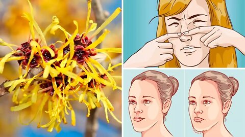 How to Use Witch Hazel to Clear Up Your Skin Naturally