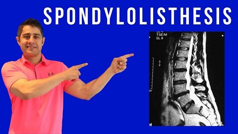Spondylolisthesis Cause, Symptoms and treatment for pain relief
