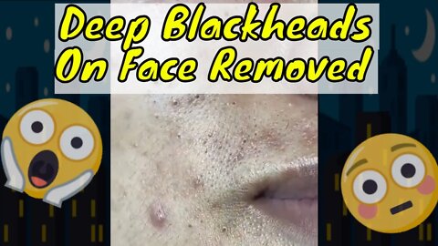 Deep blackheads on face getting removed 🫣 #blackheadremoval #blackhead #blackheads #satisfying