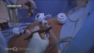 Cleveland Clinic conducts first laparoscopic living donor liver transplant