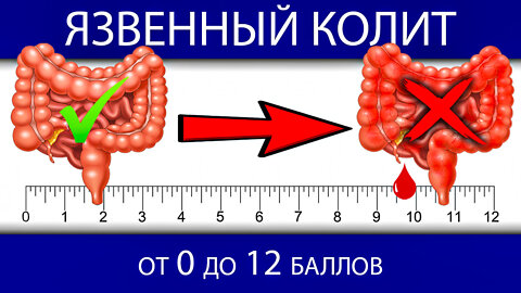 Тяжесть атаки язвенного колита по индексу Мейо