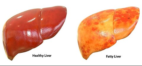 1 Teaspoon Cleans Out Fat in Your Liver