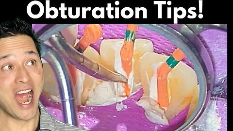 Root Canal Obturation Simplified - Tips to Save You Time!