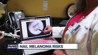 Nail melanomas