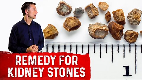 The Great Remedy to Prevent Kidney Stones – Dr. Berg