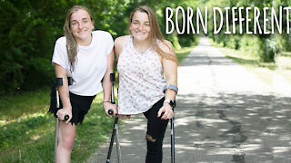 The Twins Who Used To Share One Body | BORN DIFFERENT