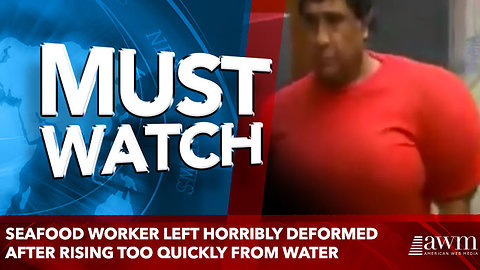 Seafood worker left horribly deformed after rising too quickly from water
