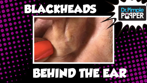 Blackheads PLUS biggest blackhead behind ear throwback!