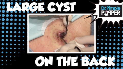 Large Epidermoid Cyst Excised on the Back