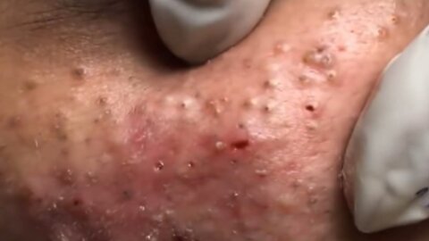 Huge Acne Pimples Blackheads Popping Up Satisfying with Oddly Calm Music