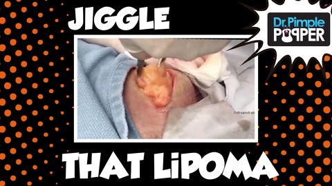Jiggle That Lipoma, Just a Little Bit