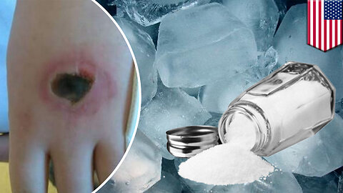 Salt and ice challenge leaves severe burn on UK schoolboy’s hand - TomoNews