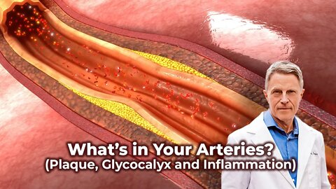 What’s in Your Arteries? (Plaque, Glycocalyx & Inflammation)