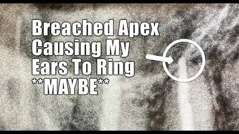 Ringing in my ear SOLVED *maybe* breached apex Juarez #Mexico #Tinnitus