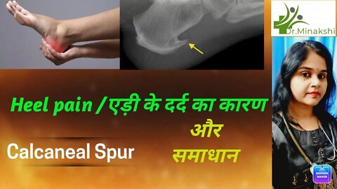 Calcaneal spur || Heels pain|| एड़ी का दर्द, कारण और उपचार #calcanealsup #heelspain