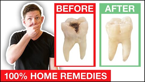 😃 How to Heal Cavities Naturally Without The Dentist!
