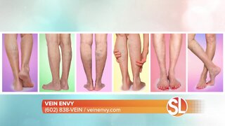 Vein Envy offers a minimally invasive techniques to treat vein disease