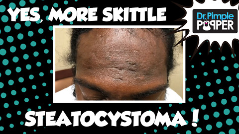 YES, More Skittle Steatocystoma - Session 6