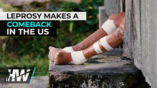 LEPROSY MAKES A COMEBACK IN THE US