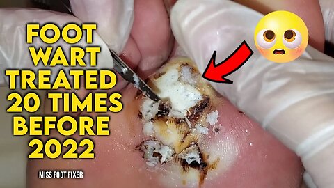 BIGGEST FOOT WART EVER??? [TREATED 20 TIMES BEFORE ] BY FOOT DOCTOR MISS FOOT FIXER