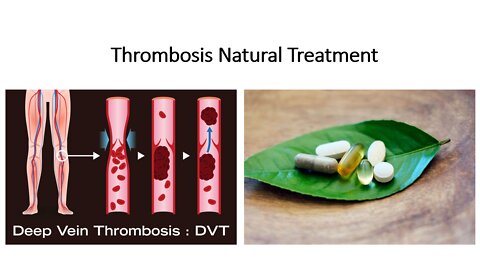 Thrombosis Natural Treatment