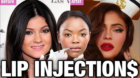 MY perspective of LIP INJECTIONS that may PISS YOU OFF