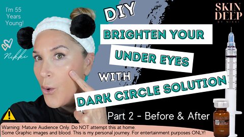 *BEFORE & AFTER* Dark Circle Treatments - Part 2