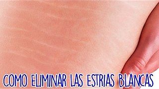 Como Eliminar Las Estrias Blancas