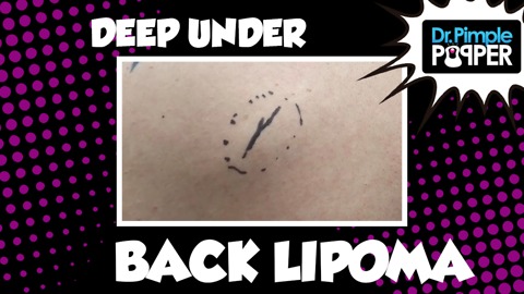 Lipoma, is it you I'm looking for?