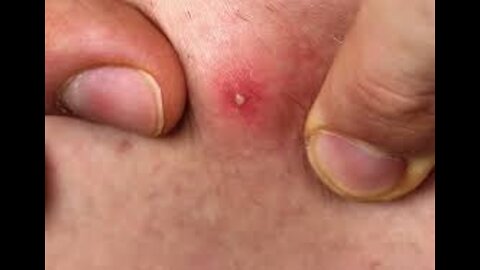 #BIGPIMPLES, #INFECTION#PIMPLES