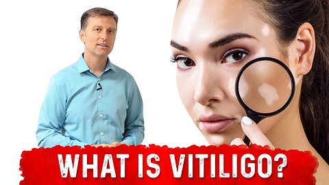 What is Vitiligo Explained By Dr. Berg