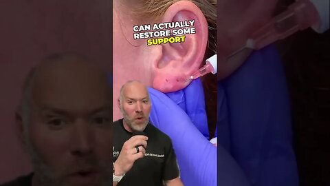 Using Filler to Restore Earlobes 👂 #shorts
