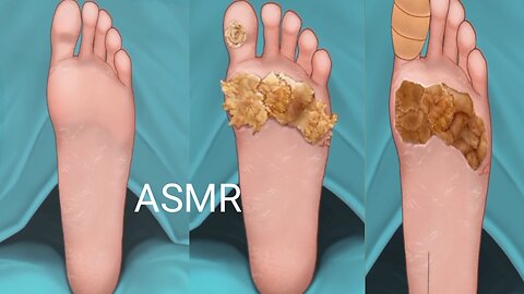 ASMR Treatment of foot Removal Animation