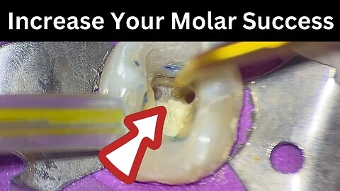 Should You Trough Mandibular Molars?