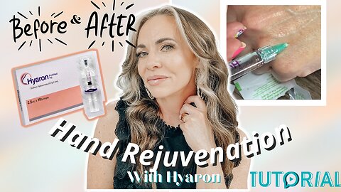 OMG! The Best HAND REJUVENATION Ever! (Hyaron)