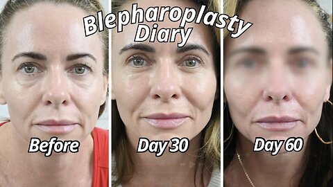 Day 60 Transformation After Eyelid Lift Surgery