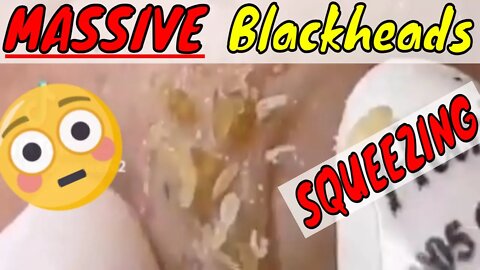 MASSIVE Blackheads Squeezing 🪱 #blackheadremoval #blackhead #blackheads #fyp #fypage #fypviral